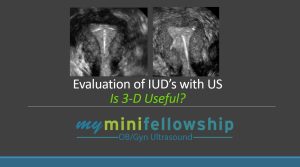 US Evaluation of IUD – Is 3-D Useful